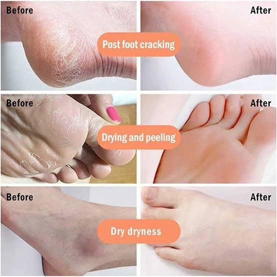 کرم ترک و خشکی پا وکالی